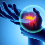 Arthritis Symptome erkennen und behandeln
